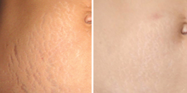 MIcro-needle-stretch-marks-abdomen