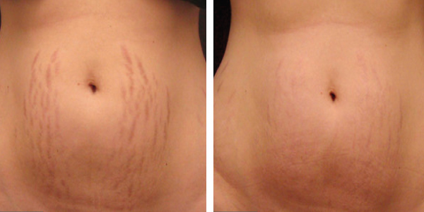 micro needling for scars