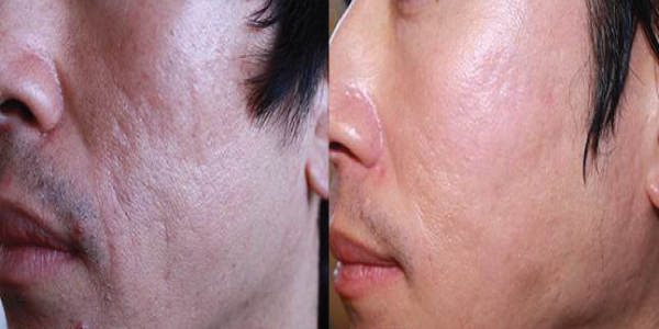 Microneedling-before-and-after-gallery