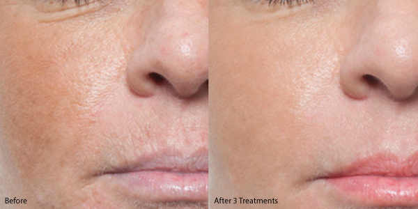 How Soon Can You Use Retinol After Microneedling