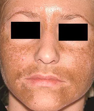 There are many procedures available to treat pigmentation issues. Microneedling, IPL, Laser Genesis and Fractional CO2 Laser, in conjunction with chemical peels and home care products  can tackle this problem. We will discuss if micro needling can help with hyper and hypo-pigmentation and how best to treat.